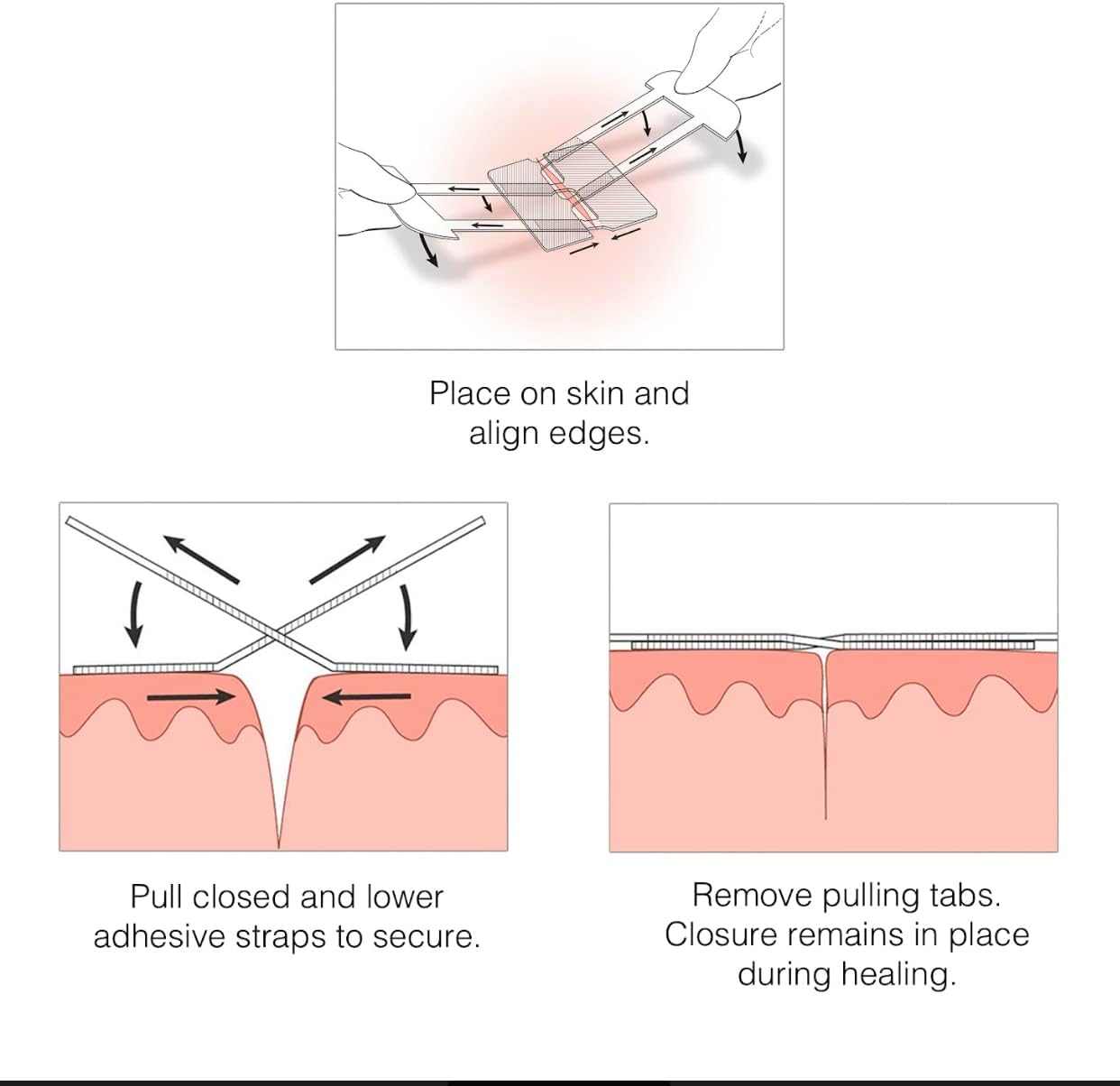 Application instructions for Clozex Emergency Laceration Closures, demonstrating how to align skin edges and secure closure for wound healing.